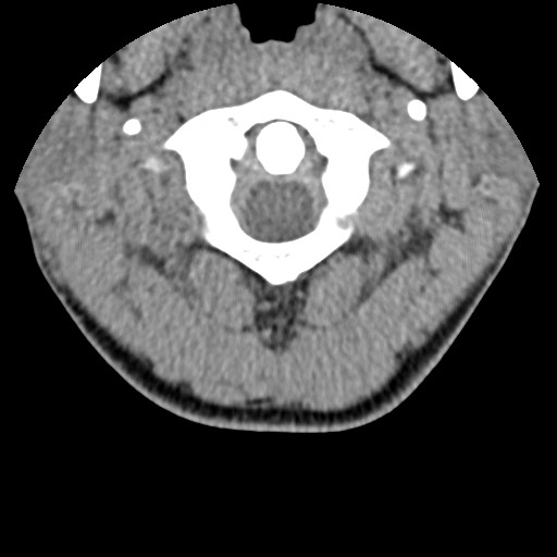 C5 facet fracture (Radiopaedia 58374-65499 Axial non-contrast 14).jpg
