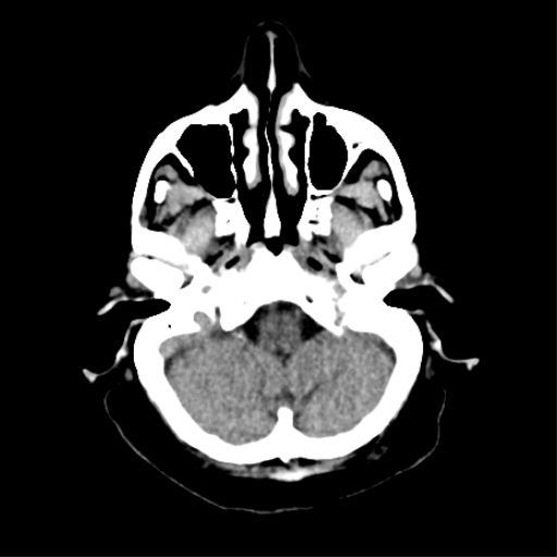 File:CNS Lymphoma (Radiopaedia 44198-47794 Axial non-contrast 7).png