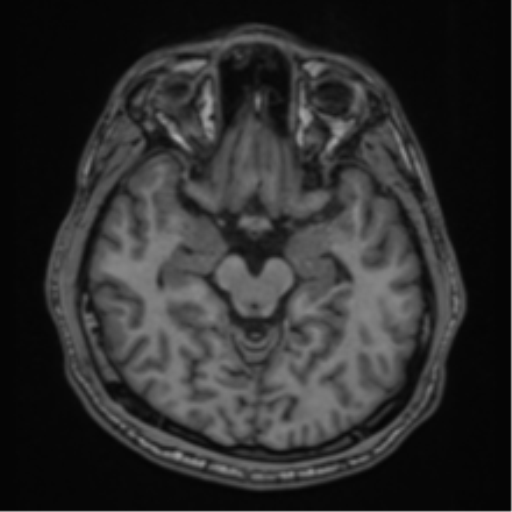 CNS vasculitis (Radiopaedia 55715-62263 Axial T1 11).png