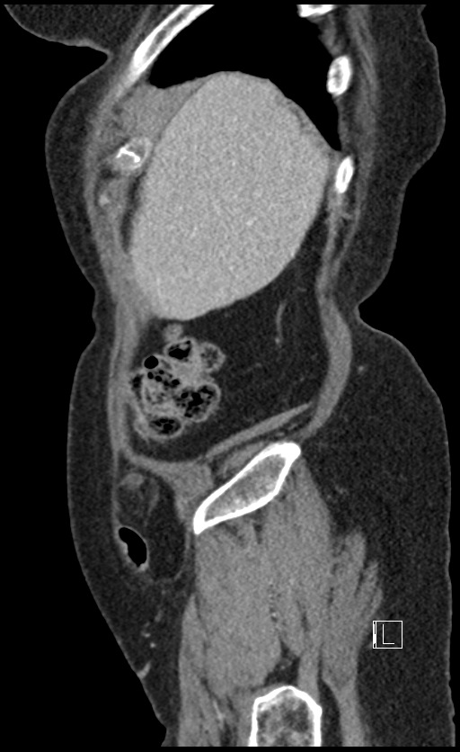 Calcified adrenal glands and Spigelian hernia (Radiopaedia 49741-54988 C 142).jpg