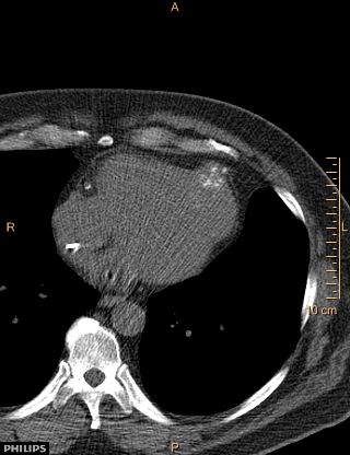 File:Calcified cardiac fibroma (Radiopaedia 39267-41519 Axial non-contrast 9).jpg