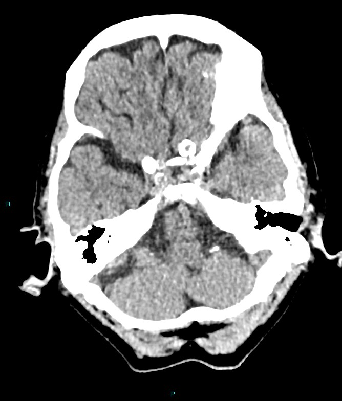 Calcified cerebral emboli from left ventricular thrombus (Radiopaedia 84420-99758 Axial non-contrast 72).jpg