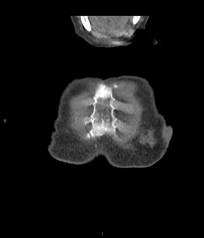 Calcified cerebral emboli from left ventricular thrombus (Radiopaedia 84420-99760 Coronal C+ CTPA 70).jpg