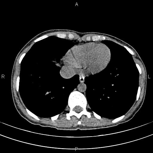 File:Calcified hepatic hydatid cyst (Radiopaedia 83870-99072 Axial non-contrast 6).jpg