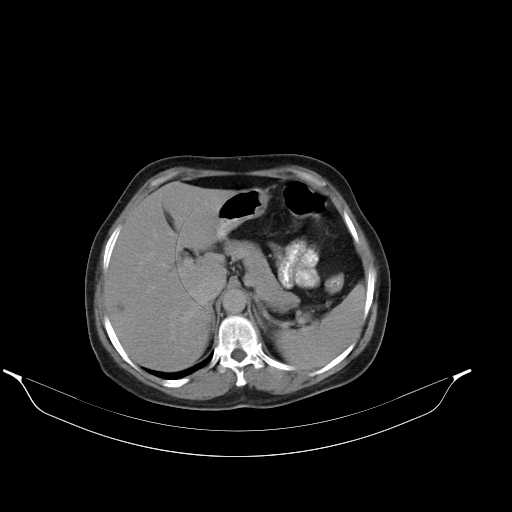 File:Calcified hydatid cyst of the liver (Radiopaedia 21212-21112 Axial C+ delayed 15).jpg