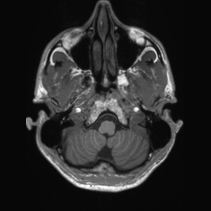 Callosal dysgenesis with interhemispheric cyst (Radiopaedia 53355-59335 Axial T1 22).jpg