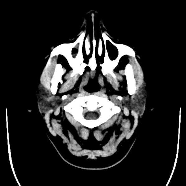 Calvarial osteoma (Radiopaedia 36520-38079 Axial non-contrast 1).jpg