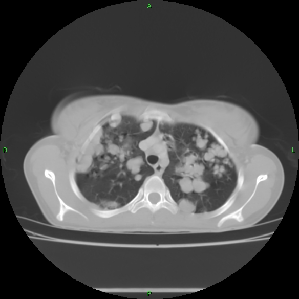 File:Cannon ball metastases - synovial sarcoma (Radiopaedia 26135-26271 Axial lung window 10).jpg