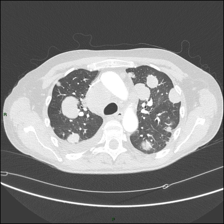 Cannonball metastases (Radiopaedia 82110-96150 Axial lung window 70).jpg