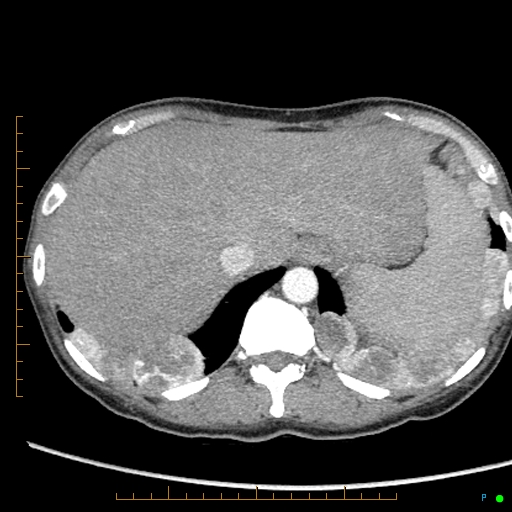 Canonball lung metastasis (Radiopaedia 77634-89837 B 91).jpg