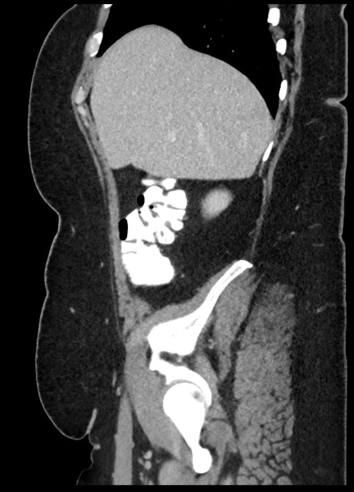 Carcinoid tumor - terminal ileum (Radiopaedia 60931-68739 C 83).jpg