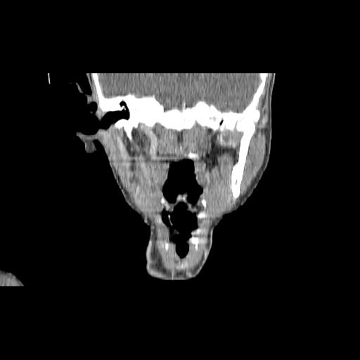 Carcinoma of the maxillary antrum (Radiopaedia 53805-59888 Coronal C+ delayed 89).jpg