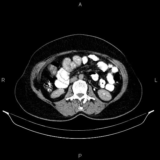 File:Carcinoma of uterine cervix (Radiopaedia 85861-101700 Axial C+ delayed 34).jpg