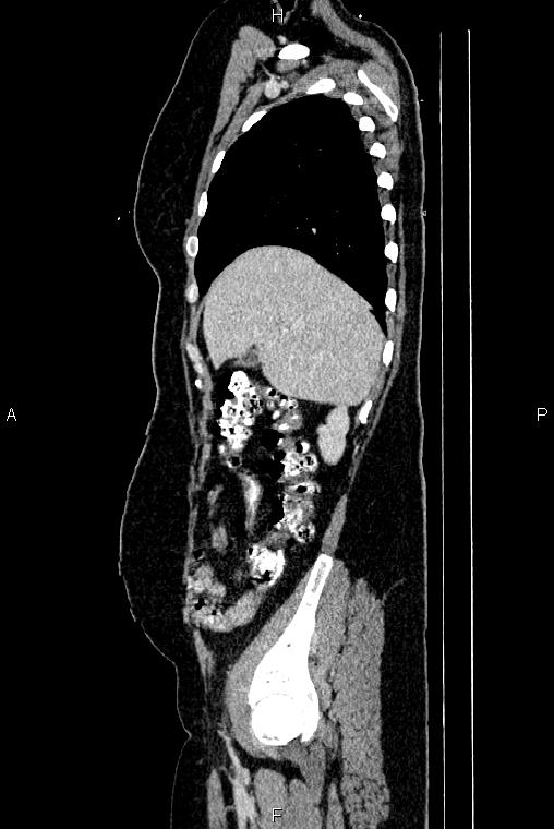 Carcinoma of uterine cervix (Radiopaedia 85861-101700 D 14).jpg