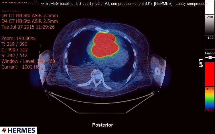 File:Cardiac lymphoma (Radiopaedia 38690-40871 Integrated PET-CT 14).jpg