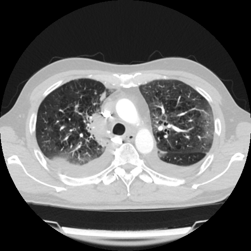 Cardiac tamponade (Radiopaedia 78607-91368 Axial lung window 23).jpg
