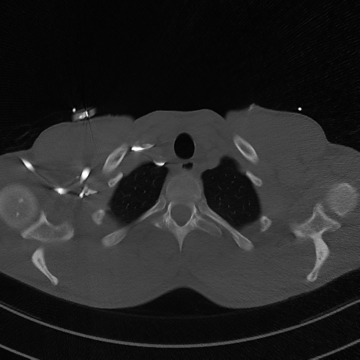 Cardiac tumor - undifferentiated pleomorphic sarcoma (Radiopaedia 45844-50134 Axial bone window 7).png