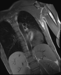 File:Cardiac tumor - undifferentiated pleomorphic sarcoma (Radiopaedia 45844-50136 Oblique T1 4).png