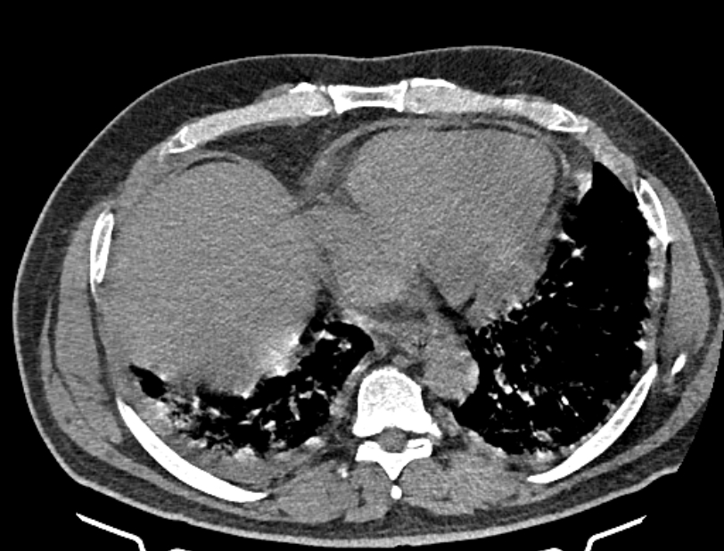 Cardiogenic pulmonary edema (Radiopaedia 68180-77678 Axial non-contrast 38).jpg