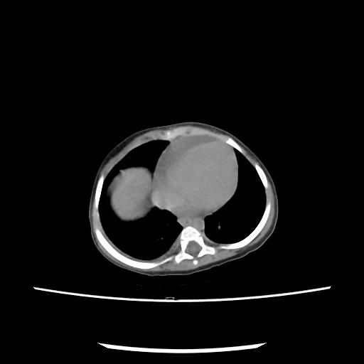 Caroli disease with autosomal recessive polycystic kidney disease (ARPKD) (Radiopaedia 89651-106703 E 8).jpg