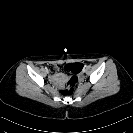File:Caroli disease with medullary sponge kidney (Radiopaedia 82622-96804 C 65).jpg