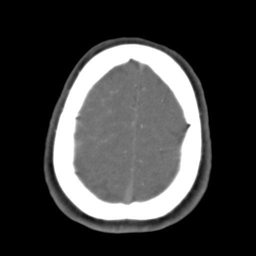 Carotico ophthalmic aneurysm (Radiopaedia 42916-46148 A 10).png