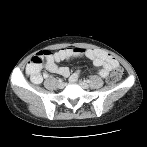 Castleman disease with fibrous pseudotumor in the abdomen (Radiopaedia 77296-89373 A 87).jpg