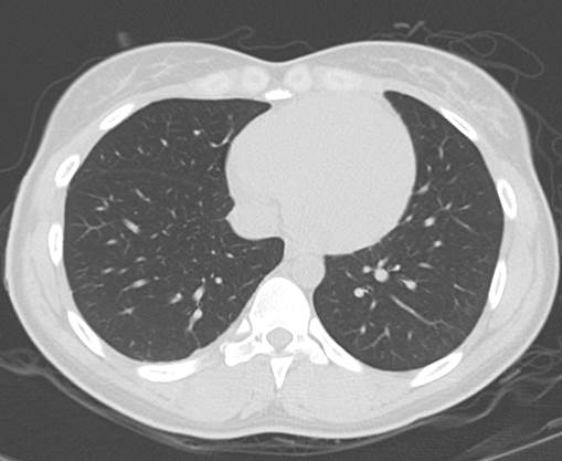 File:Catamenial pneumothorax (Radiopaedia 54382-60600 Axial 46).png
