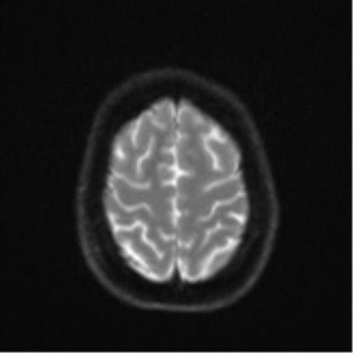 File:Cavernoma with bleed - midbrain (Radiopaedia 54546-60774 Axial DWI 23).png