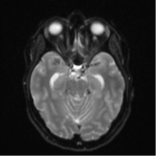File:Cavernoma with bleed - midbrain (Radiopaedia 54546-60774 Axial DWI 9).png