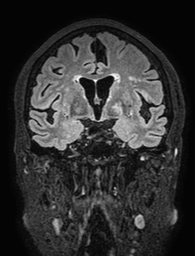 Cavernous hemangioma of the cerebellar falx (Radiopaedia 73025-83724 Coronal FLAIR 152).jpg