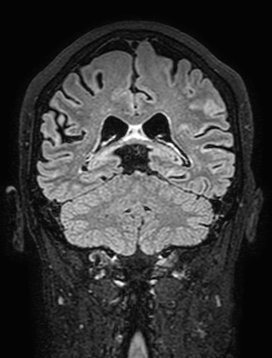 Cavernous hemangioma of the cerebellar falx (Radiopaedia 73025-83724 Coronal FLAIR 231).jpg