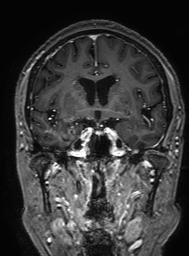 Cavernous hemangioma of the cerebellar falx (Radiopaedia 73025-83724 Coronal T1 C+ 161).jpg