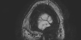Cavernous hemangioma of the cerebellar falx (Radiopaedia 73025-83724 Sagittal BOLD 198).jpg