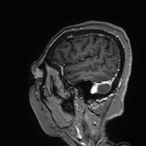 File:Cavernous hemangioma of the cerebellar falx (Radiopaedia 73025-83724 Sagittal T1 C+ 178).jpg