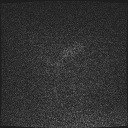 Cavernous sinus meningioma (Radiopaedia 63682-72367 Sagittal T1 C+ 176).jpg