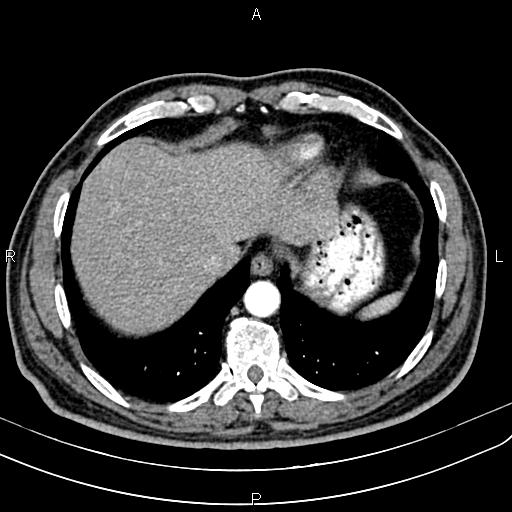 Cecal cancer with appendiceal mucocele (Radiopaedia 91080-108651 A 53).jpg