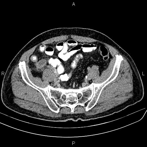 File:Cecal cancer with appendiceal mucocele (Radiopaedia 91080-108651 Axial C+ delayed 61).jpg