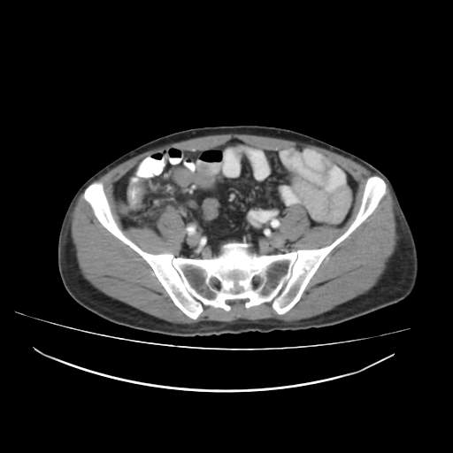 Cecal carcinoma with local lymphadenopathy (Radiopaedia 31428-32240 A 39).jpg