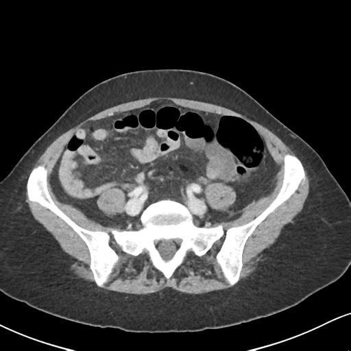Cecal internal hernia through the foramen of Winslow (Radiopaedia 44820-48651 B 53).png