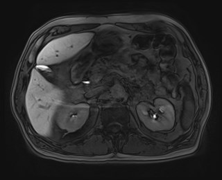 Cecal mass causing appendicitis (Radiopaedia 59207-66532 K 47).jpg