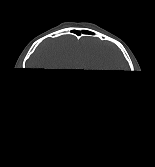 Cemento-ossifying fibroma (Radiopaedia 46243-50643 Axial bone window 8).png