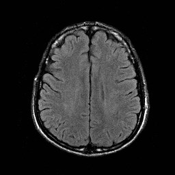 File:Central-variant posterior reversible encephalopathy syndrome (PRES) (Radiopaedia 43880-47359 Axial FLAIR 16).jpg