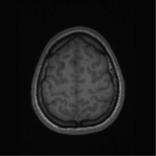 File:Central neurocytoma (Radiopaedia 37664-39557 Axial T1 62).png