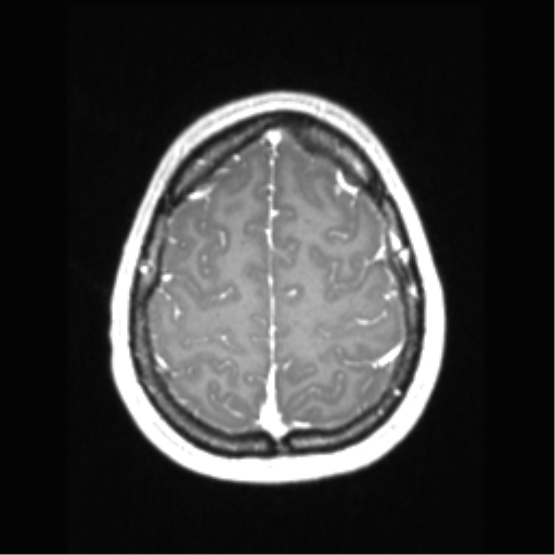 File:Central neurocytoma (Radiopaedia 37664-39557 Axial T1 C+ 66).png