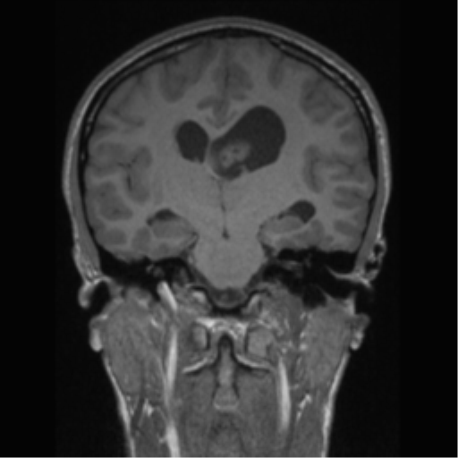 Central neurocytoma (Radiopaedia 37664-39557 Coronal T1 43).png