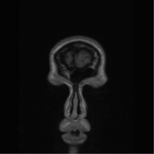 Central neurocytoma (Radiopaedia 37664-39557 Coronal T1 86).png