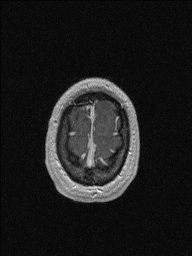 Central neurocytoma (Radiopaedia 56690-63469 Axial T1 C+ 151).jpg