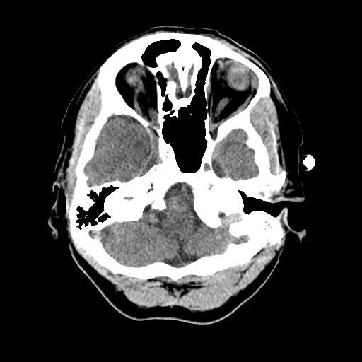 Central neurocytoma (Radiopaedia 68725-78432 Axial non-contrast 9).jpg