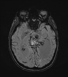 Central neurocytoma (Radiopaedia 84497-99872 Axial SWI 32).jpg